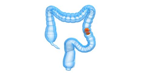 Colitis Vs. Cancer 的图像结果