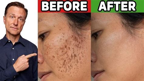 natural remedies 2022 hyperpigmentation cream