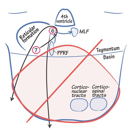 What Is Locked In Syndrome
