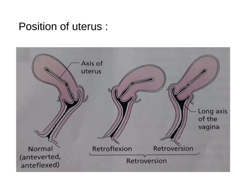 Can Your Uterus Fall Out