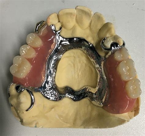 Removable Denture | Mega Dental
