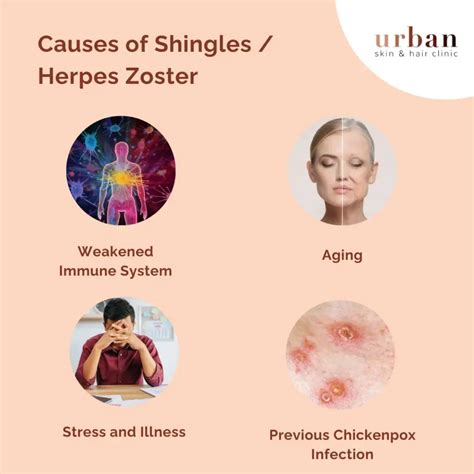 Shingles Symptoms Tips For Treating And Preventing Shingles Your