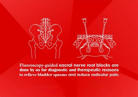 Sacral Nerve Root Block | Atlas Pain Care