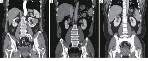 Image result for Retroperitoneal Approach Nephrectomy
