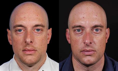 Plastic Surgery Elf Ears Elfie (@__elfie___) Ear Pointing Journey: