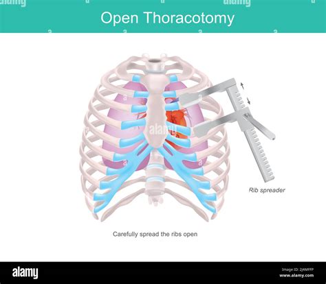 Image result for Exploratory Thoracotomy