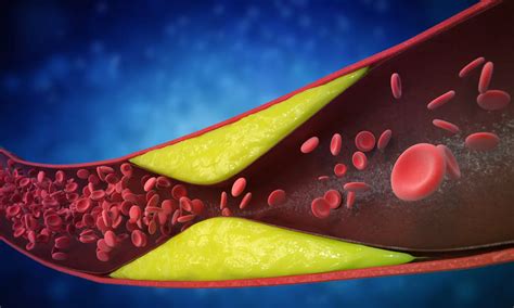 Oral PCSK9 inhibitor, AZD0780 demonstrates significant Reduction of LDL ...