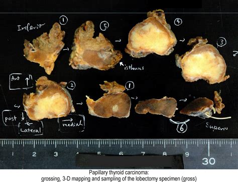 Papillary Thyroid Carcinoma Gross
