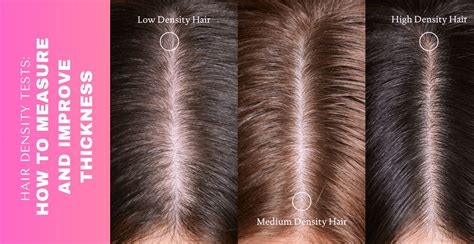 Normal Hair Density 的图像结果