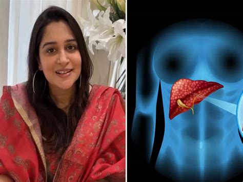 Dipika Kakar stage 2 liver cancer liver cancer symptoms