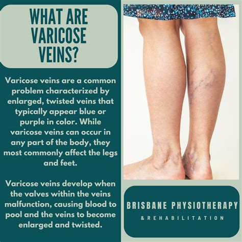 Mild Varicose Veins In Legs