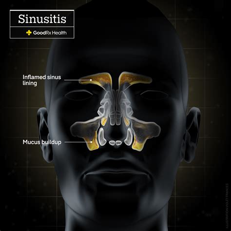 Are Sinus Infections Contagious? Causes, Symptoms, & Treatments - GoodRx