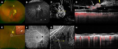 Vitreous Hemorrhage