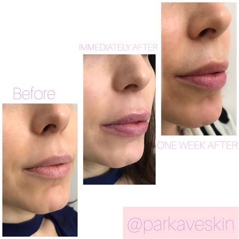 I Tried Lip Fillers For The First Time–Here’s Everything You Need To Know (Before & After Pics ...