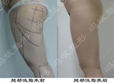 北京东方和谐整形大腿吸脂手术案例 - 整形日记 - 彩贝整容网