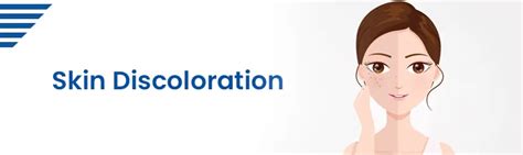 Skin Discoloration : Symptoms, Causes, Diagnostic Tests and Treatment