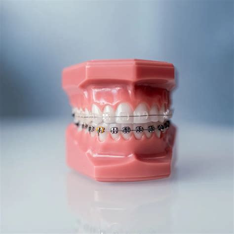 #1 Affordable Clear Braces vs Metal | Cochran Orthodontics