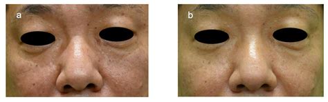 A Single Intradermal Injection of Autologous Adipose-Tissue-Derived ...