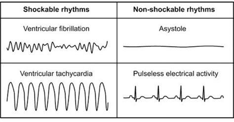 What Rhythms Will An Aed Shock at Carlos Mcclellan blog