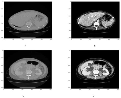 Segmentation of Liver Tumor in CT Scan Using ResU-Net