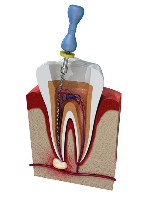 Willis Family Dental | Root Canal