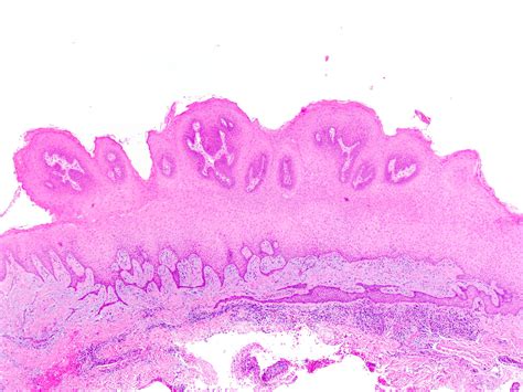 Pathology Outlines - Squamous papilloma