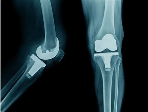 Knee Replacement Surgery Cost In India 2026 - Doctors Finder
