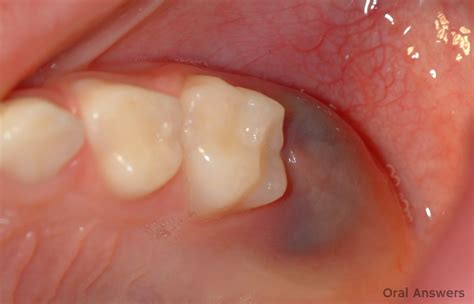 Eruption Cyst: Photos of a Purple Bump on the Gums | Oral Answers