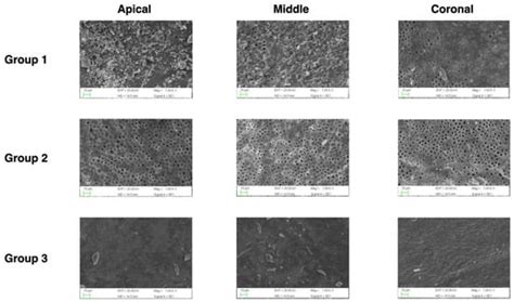 Smear Layer and Debris Removal from Root Canals Comparing Traditional ...