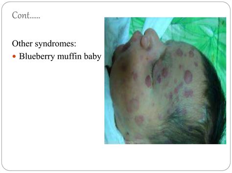 Neuroblastoma | PPTX