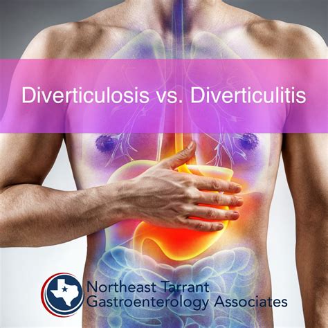 Diverticulosis & Diverticulitis | Bloating | Constipation | North Richland Hills & Fort Worth, Texas