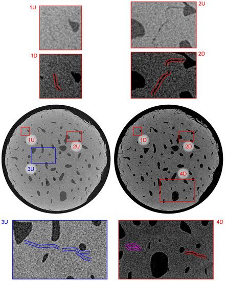 A Method for Evaluation the Fatigue Microcrack Propagation in Human ...