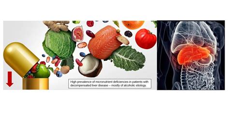 Micronutrient Deficiencies in Patients with Decompensated Liver Cirrhosis
