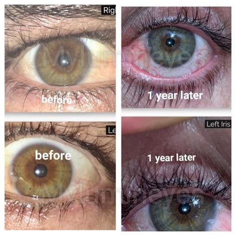 Image result for Eye Color Surgery