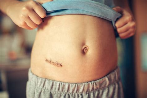 Image result for Appendix Surgery Scar