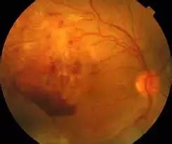 Full-field electroretinography may help evaluate retinal function in ...