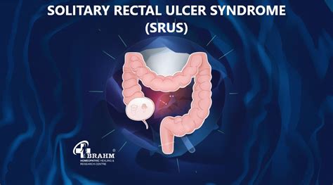 Solitary rectal ulcer syndrome treatment in homeopathy | Symptoms of ...