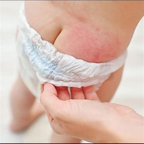 Treatment of Ahiputana (Diaper Rash) in Infants Using Shatdhauta Ghruta
