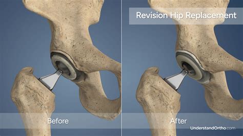 Revision Hip Replacement – UnderstandOrtho™