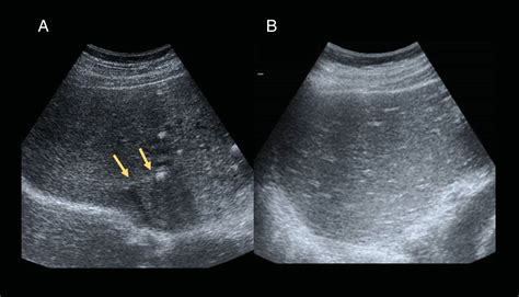 Normal and transitory ultrasonography findings in the immediate postoperative period after liver ...