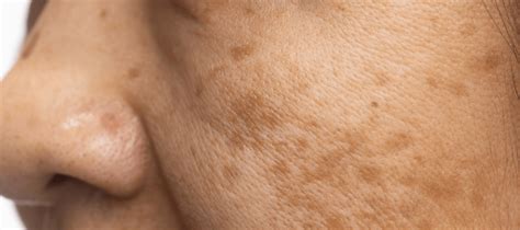 How to Get Rid of Dark Sun Spots on Your Face | The Pink Foundry