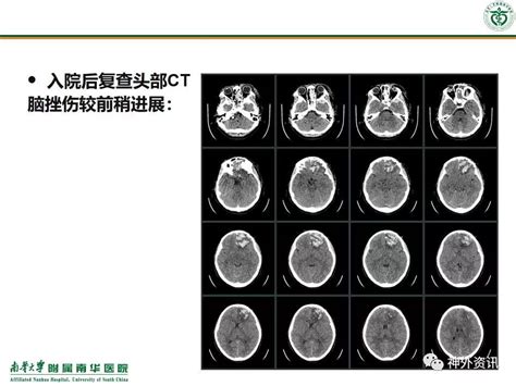 脑组织铁沉积神经变性病临床与影像诊断（二）_signal