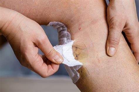 Removing Bandages After Varicose Vein Surgery Stock Photo - Download ...