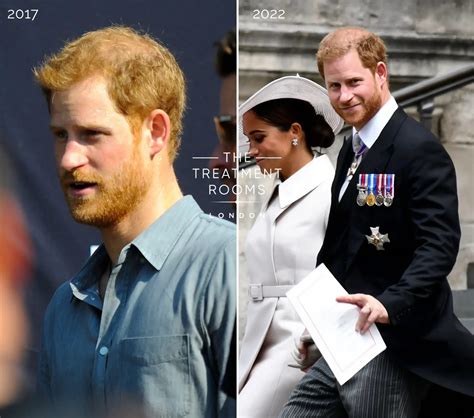 Prince Harry Hair Loss: Timeline, Treatment Options, and Insights