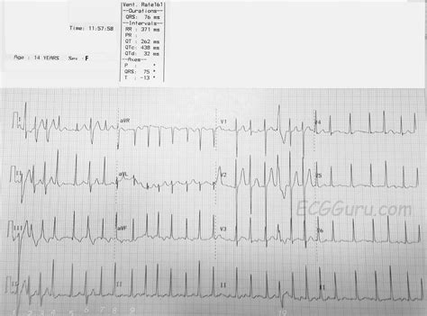 Rapid Atrial Fibrillation Ecg
