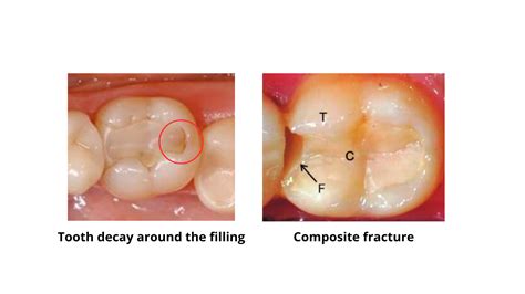 Teeth With Cavities Pictures