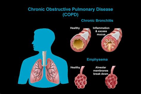 COPD: Symptoms, Causes, Types, Treatment & Prevention