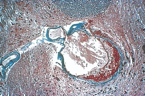 Vascular Disease - Clinical Tree