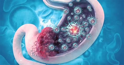 مراحل سرطان معده بر اساس سیستم TNM - تهران انکولوژی