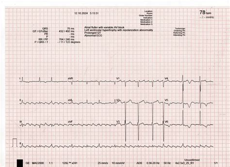 Image result for Atrial Flutter ECG Pattern